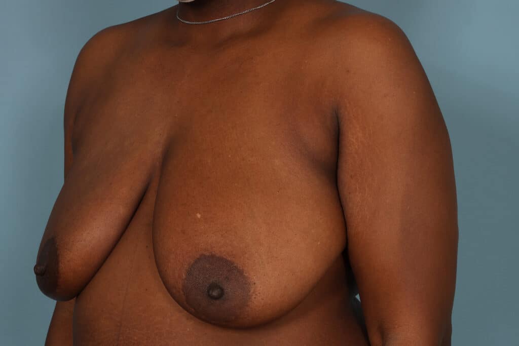 Before Image: DIEP Flap - left-front-oblique