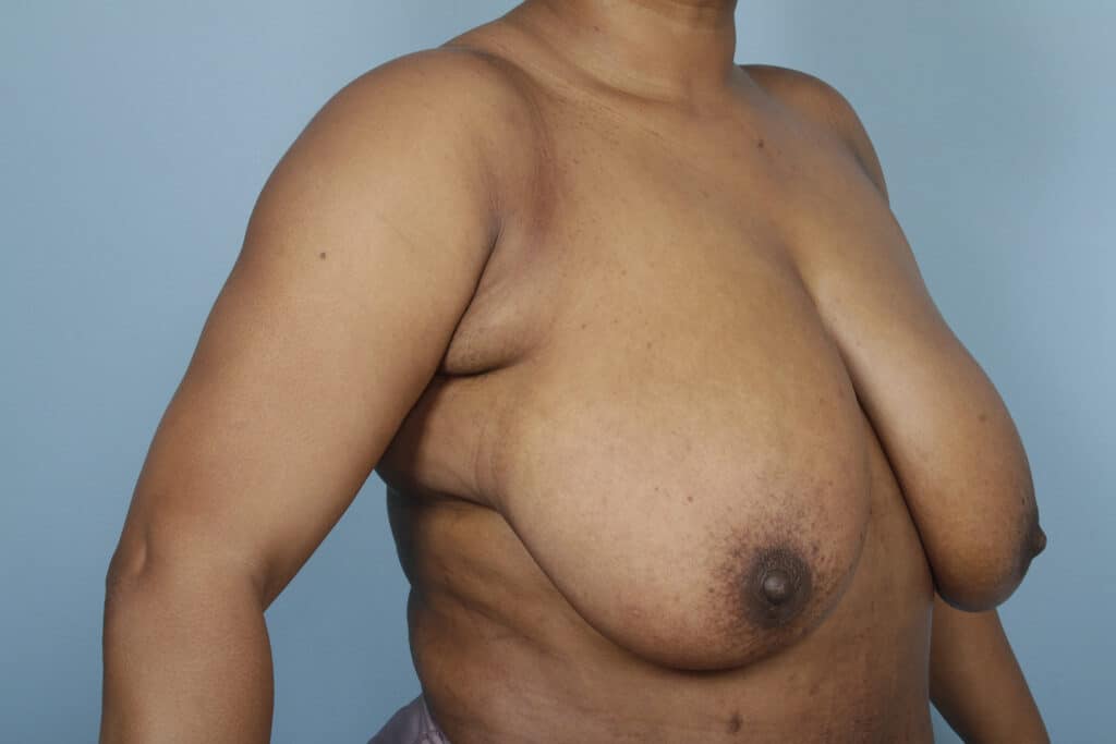 Before Image: Breast Reduction - right-front-oblique