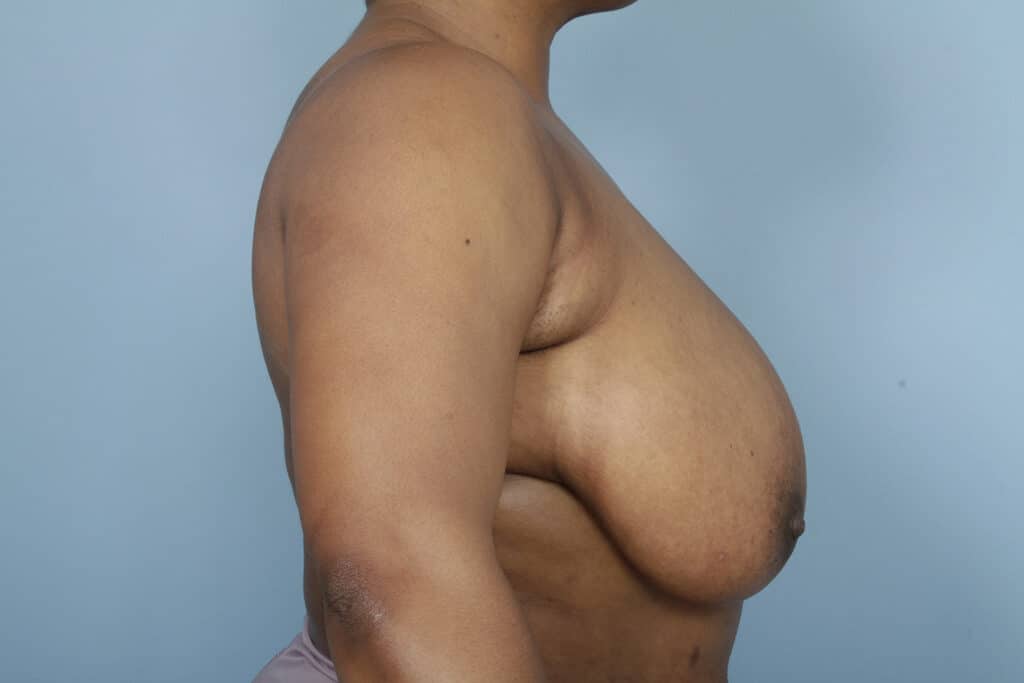 Before Image: Breast Reduction - right-side