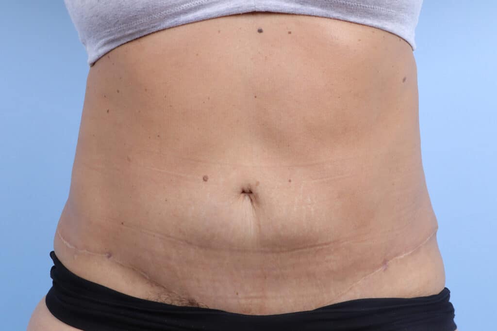 After Image: Abdominoplasty - front