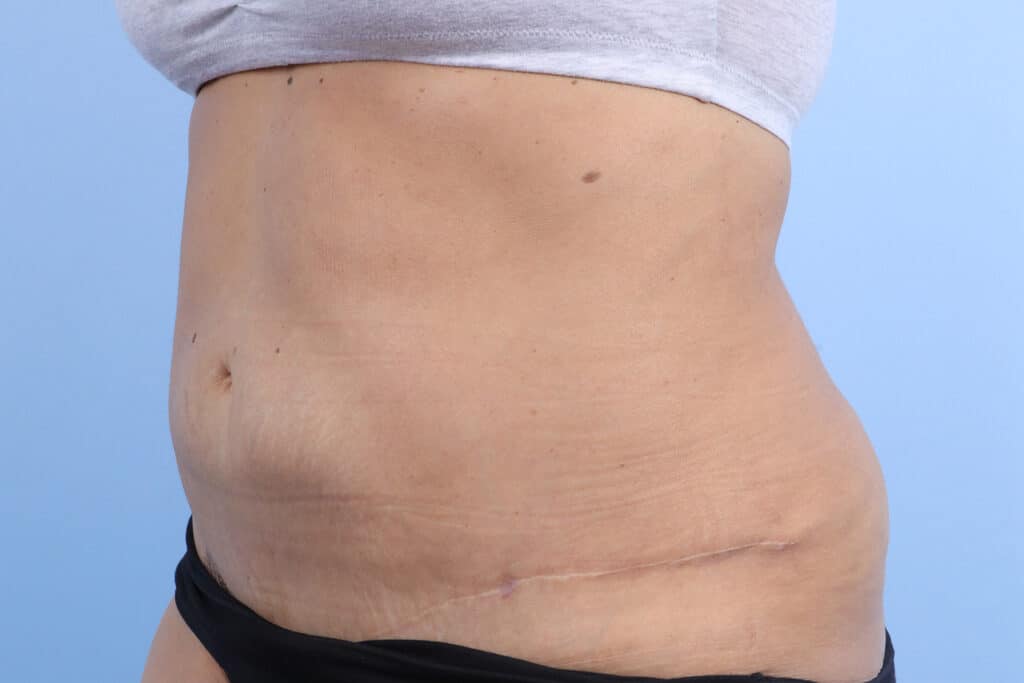 After Image: Abdominoplasty - left-front-oblique
