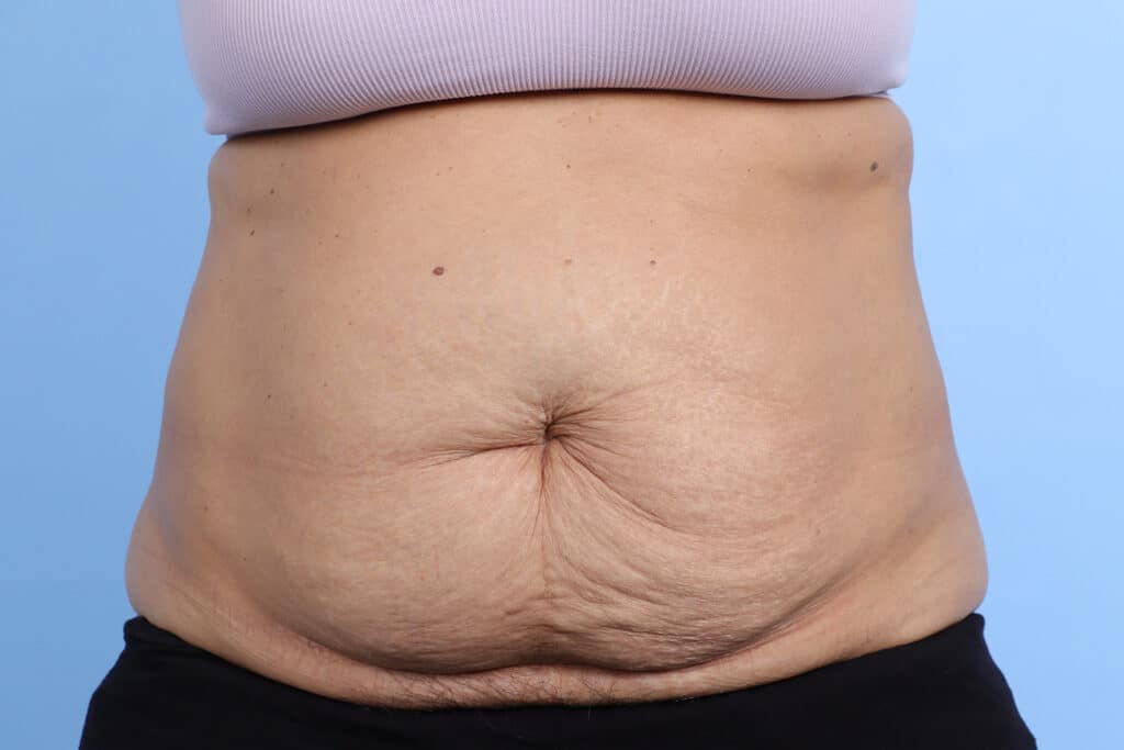Before Image: Abdominoplasty - front