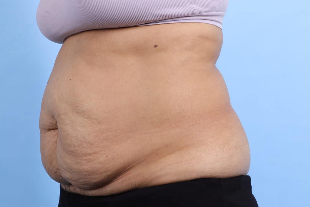Before Image: Abdominoplasty - left-front-oblique