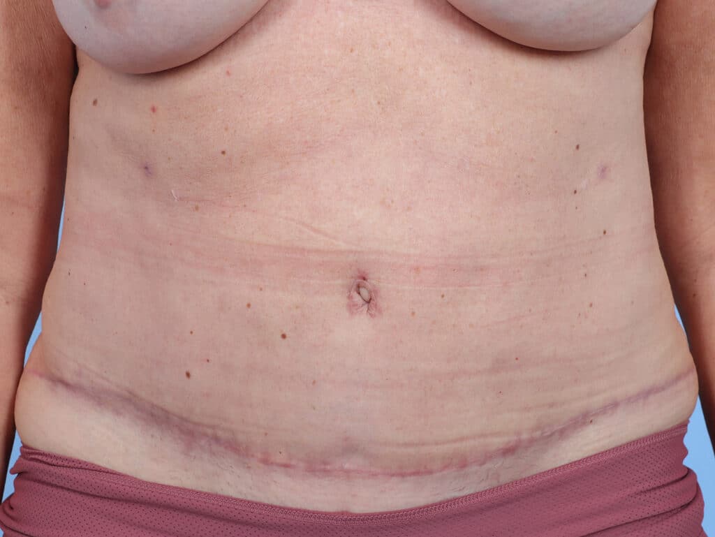 After Image: Abdominoplasty - front