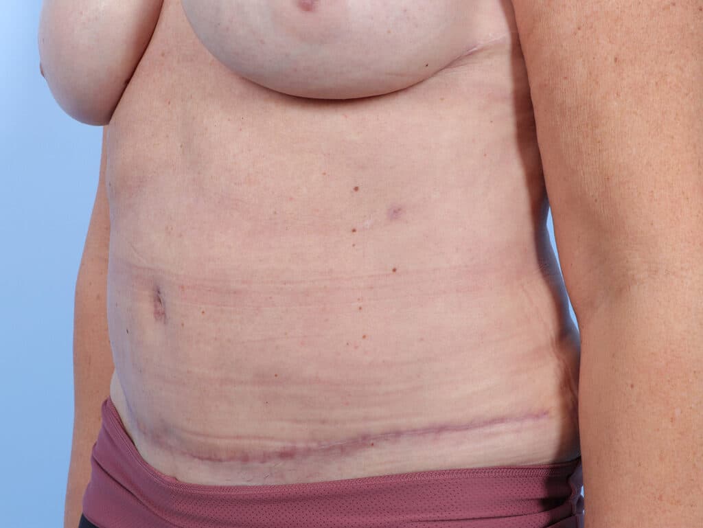 After Image: Abdominoplasty - left-front-oblique