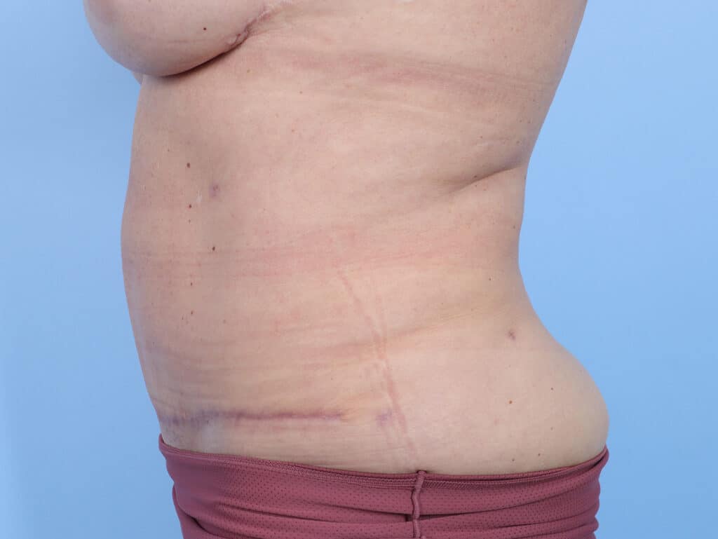 After Image: Abdominoplasty - left-side