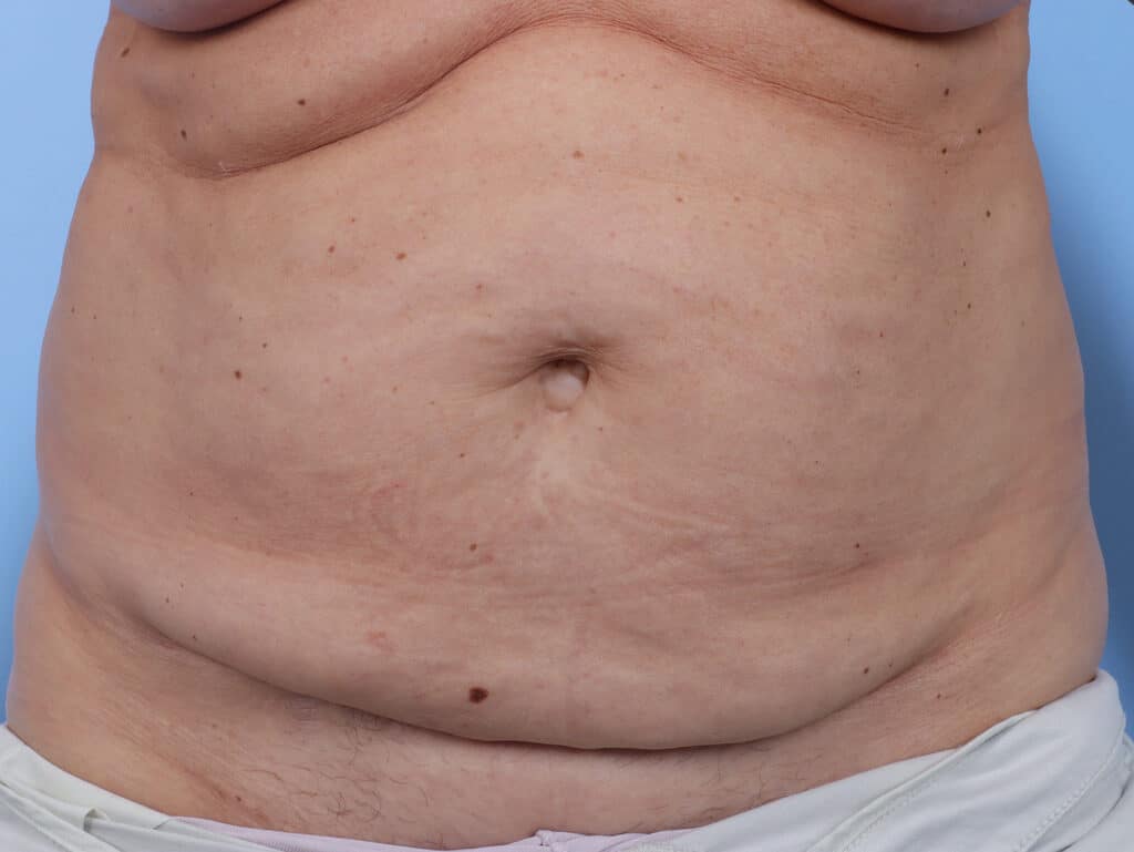 Before Image: Abdominoplasty - front