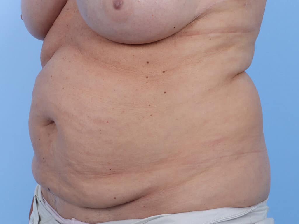 Before Image: Abdominoplasty - left-front-oblique