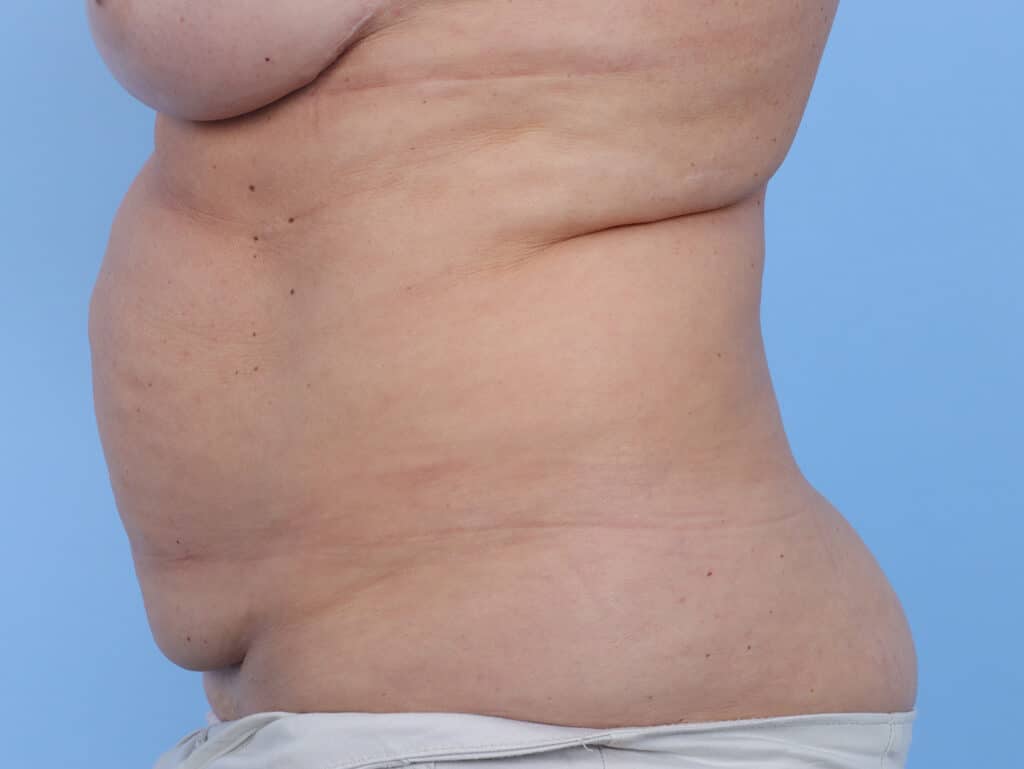 Before Image: Abdominoplasty - left-side