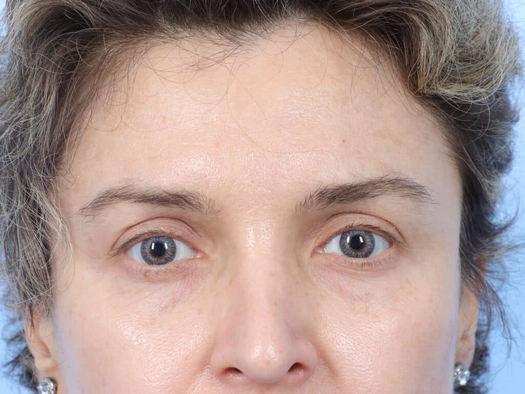 After Image: Brow Lift and Blepharoplasty - front