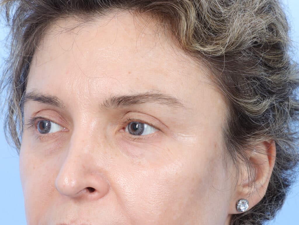 After Image: Brow Lift and Blepharoplasty - left-front-oblique