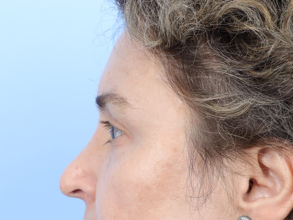After Image: Brow Lift and Blepharoplasty - left-side