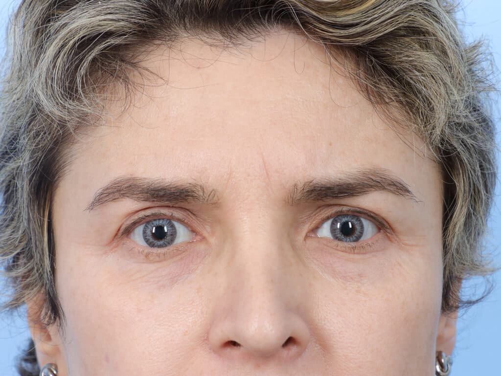 Before Image: Brow Lift and Blepharoplasty - front