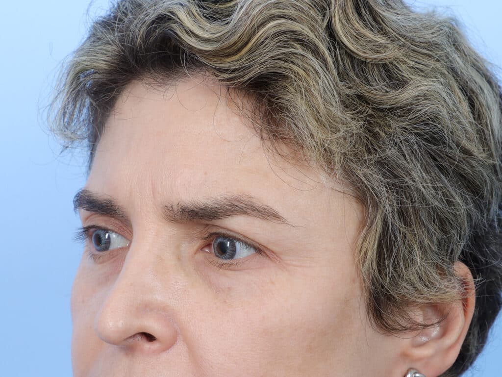 Before Image: Brow Lift and Blepharoplasty - left-front-oblique