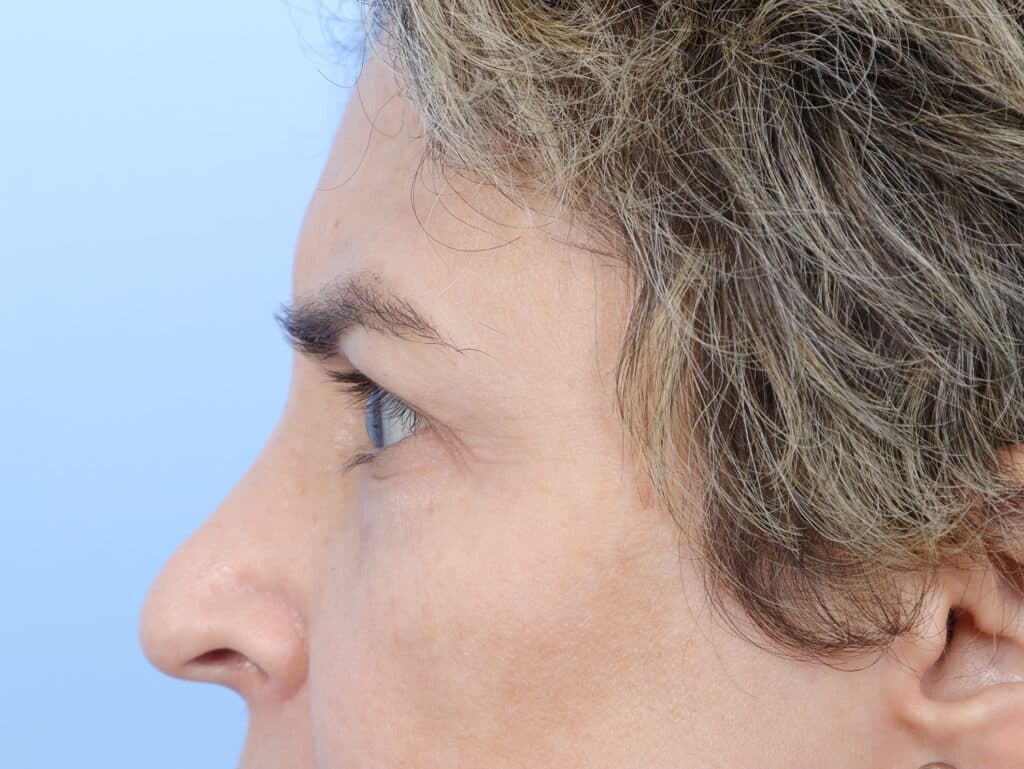 Before Image: Brow Lift and Blepharoplasty - left-side