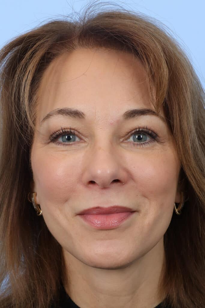 After Image: Brow Lift and Blepharoplasty - front