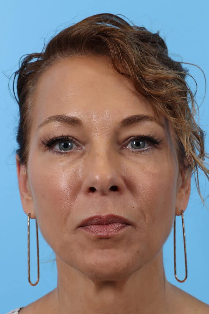 Before Image: Brow Lift and Blepharoplasty - front