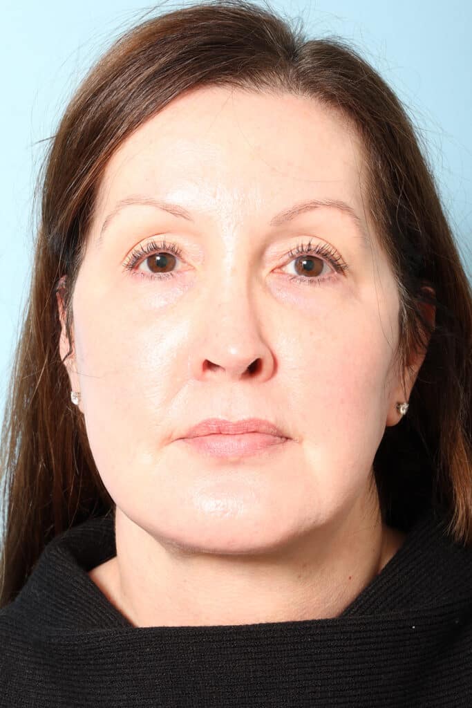 After Image: Face & Neck Lift - front