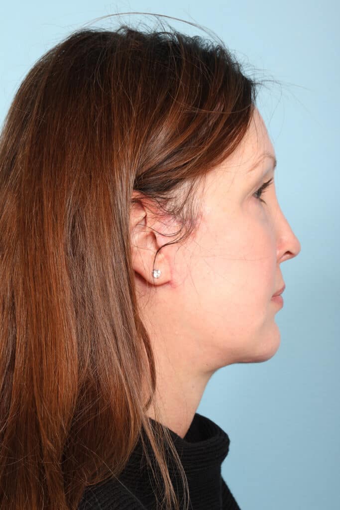 After Image: Face & Neck Lift - right-side