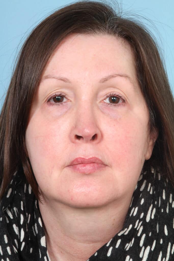 Before Image: Face & Neck Lift - front