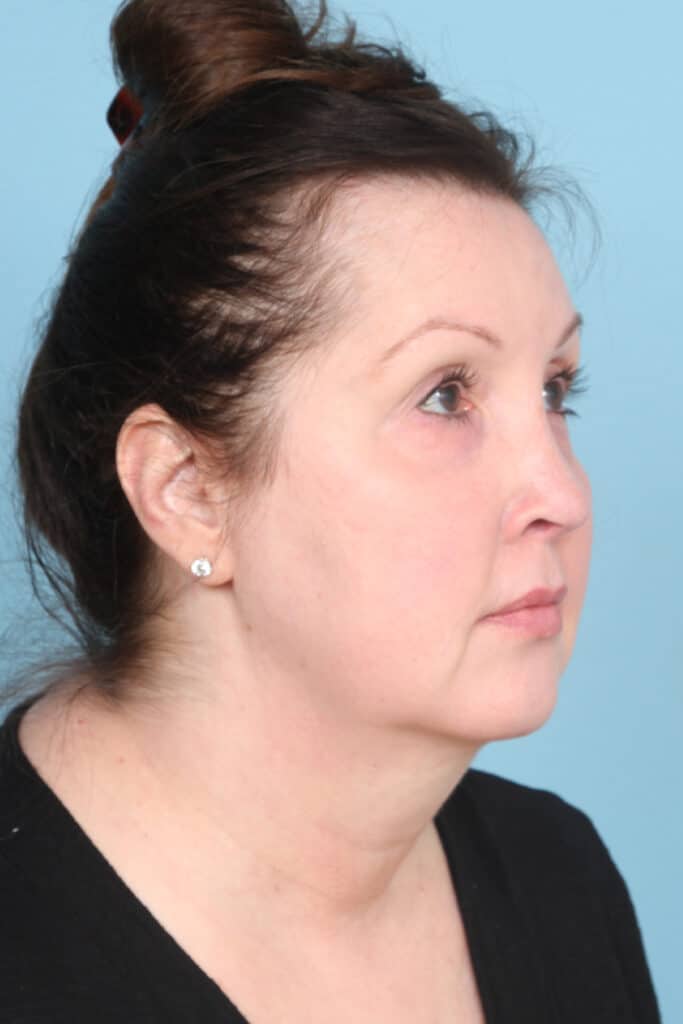 Before Image: Face & Neck Lift - right-front-oblique