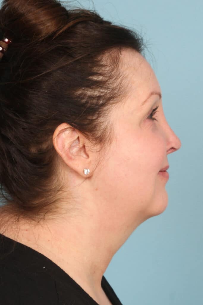 Before Image: Face & Neck Lift - right-side