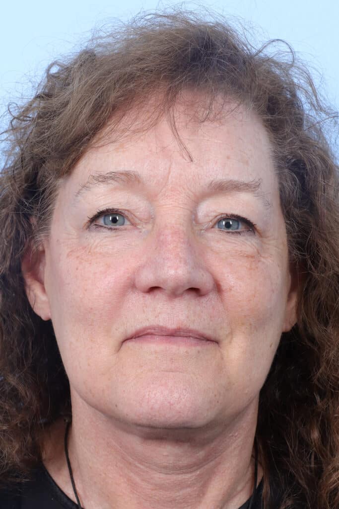 After Image: Face & Neck Lift - front