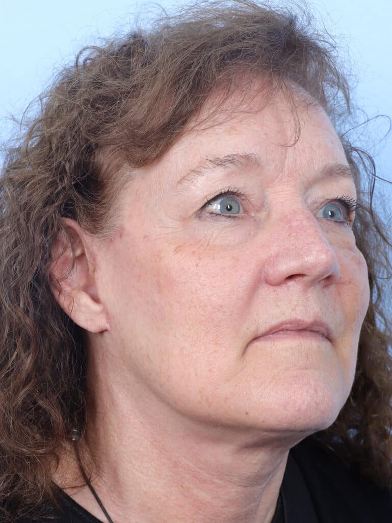 After Image: Face & Neck Lift - right-front-oblique