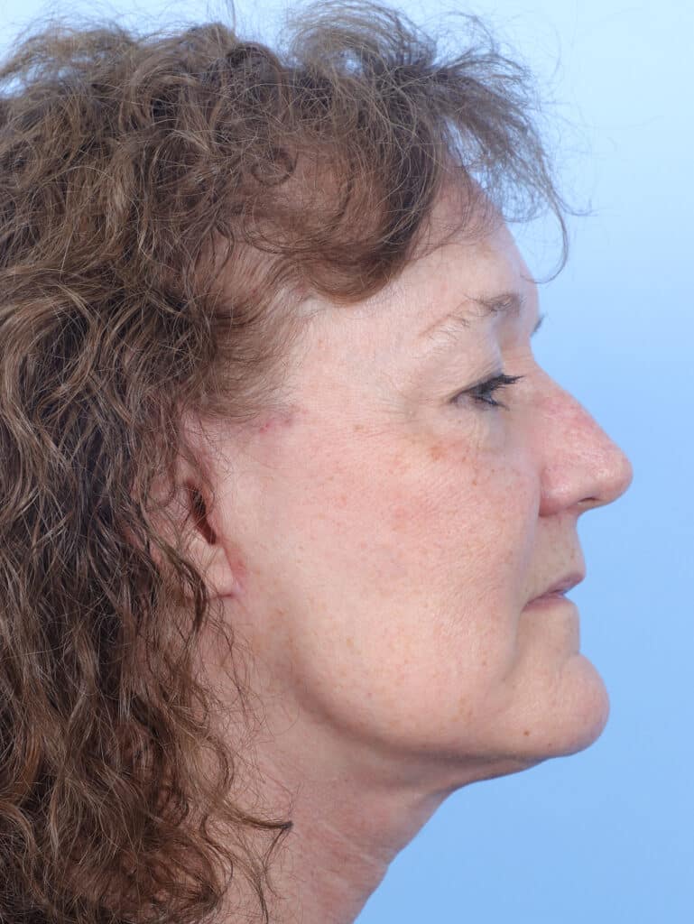 After Image: Face & Neck Lift - right-side