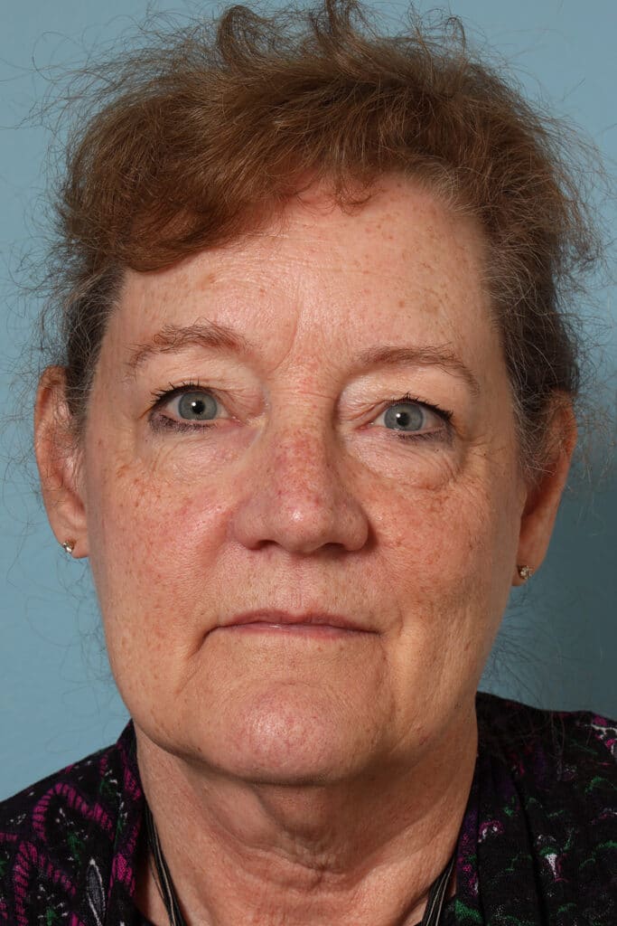 Before Image: Face & Neck Lift - front