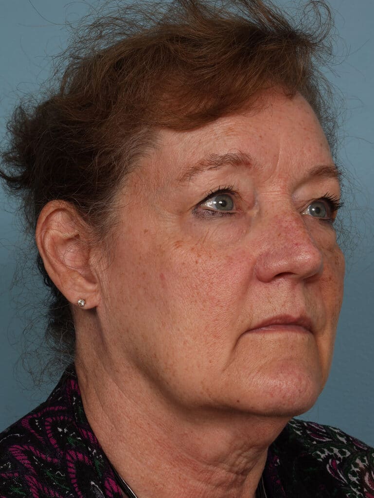 Before Image: Face & Neck Lift - right-front-oblique