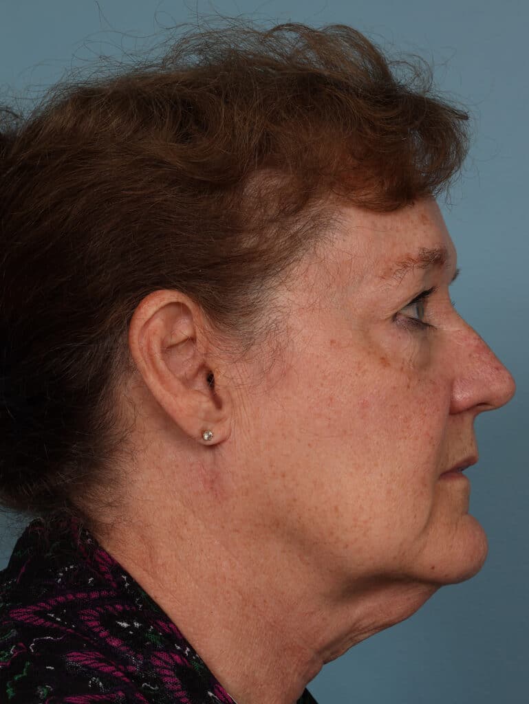 Before Image: Face & Neck Lift - right-side
