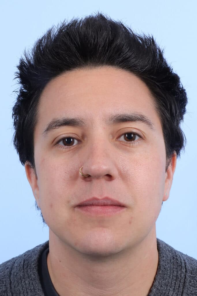 After Image: Chin Augmentation - front