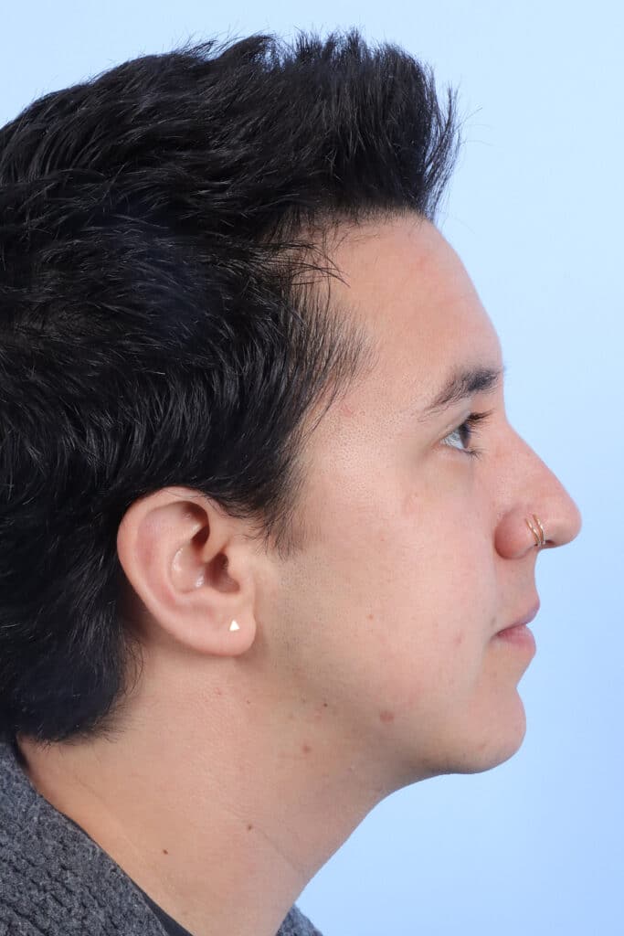 After Image: Chin Augmentation - right-side