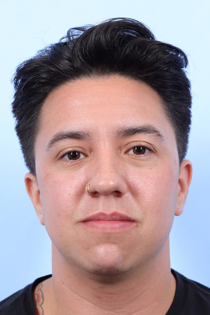 Before Image: Chin Augmentation - front
