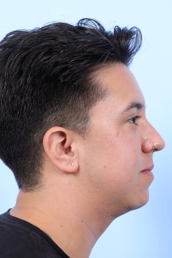 Before Image: Chin Augmentation - right-side