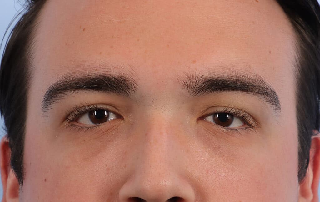 After Image: Brow Lift and Blepharoplasty - front