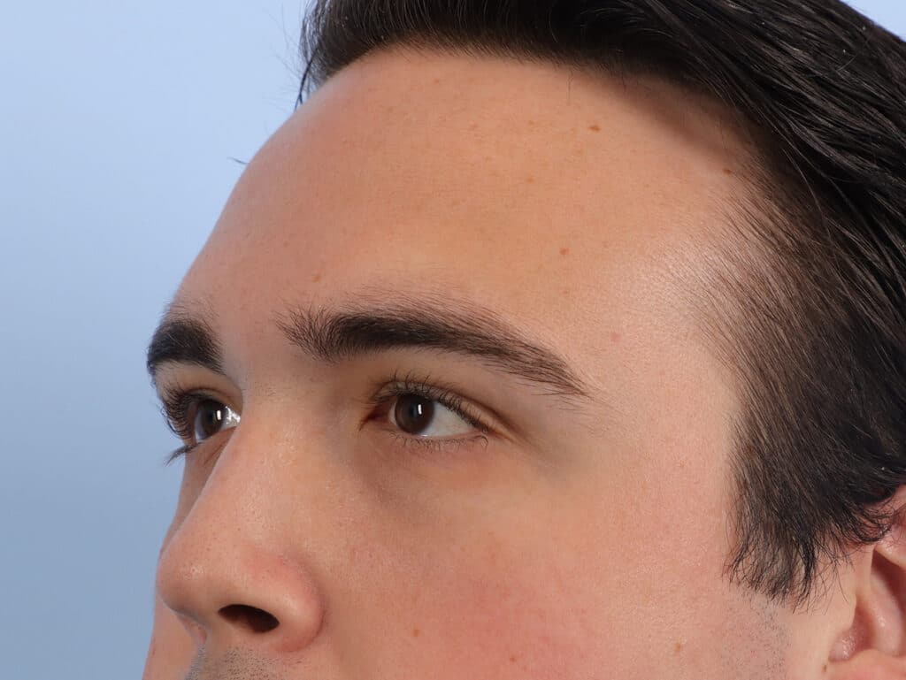 After Image: Brow Lift and Blepharoplasty - left-front-oblique