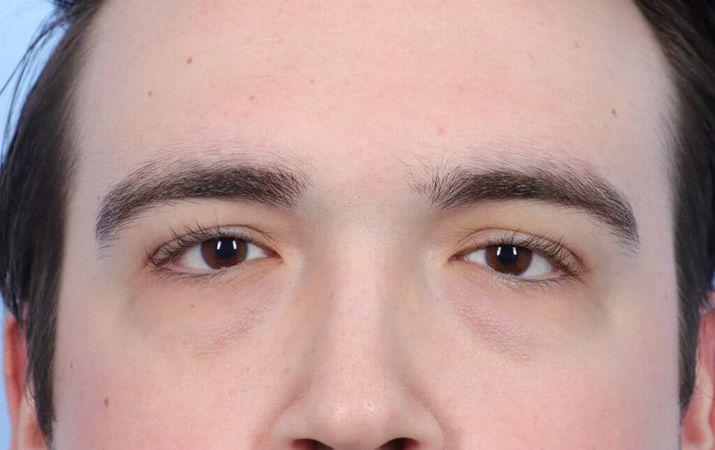 Before Image: Brow Lift and Blepharoplasty - front