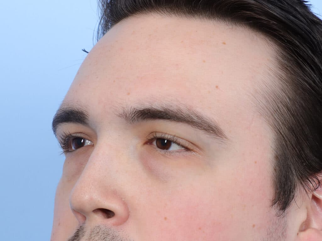 Before Image: Brow Lift and Blepharoplasty - left-front-oblique