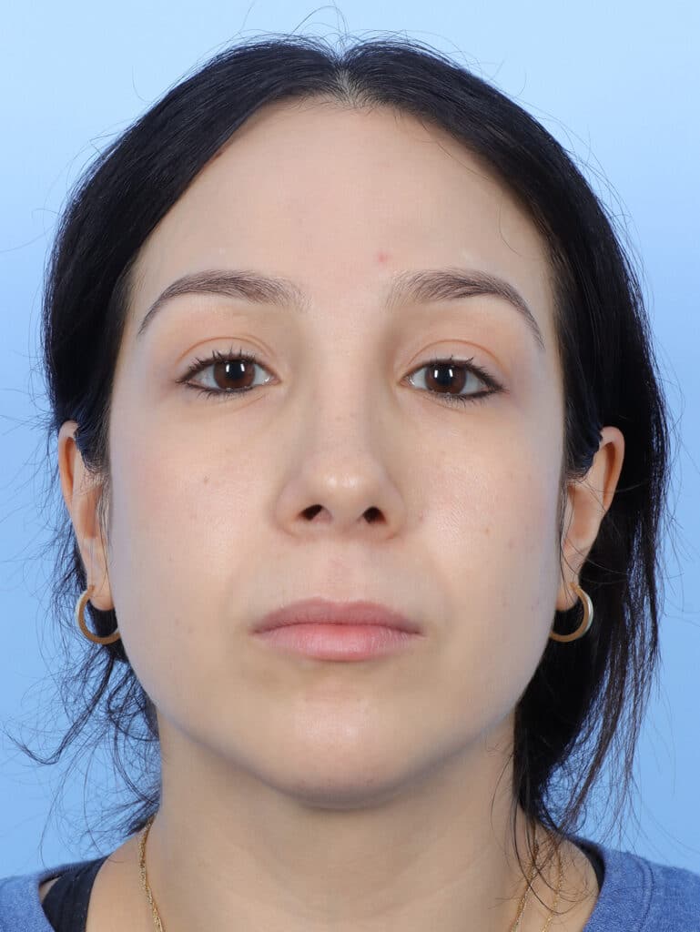 After Image: Rhinoplasty - other