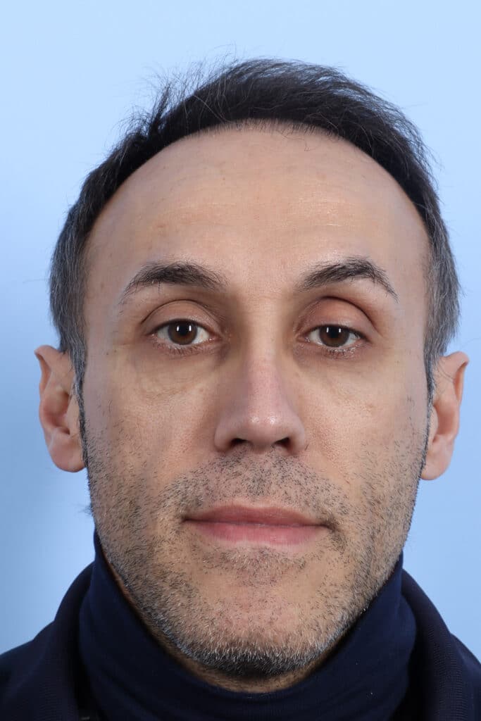 After Image: Rhinoplasty - front