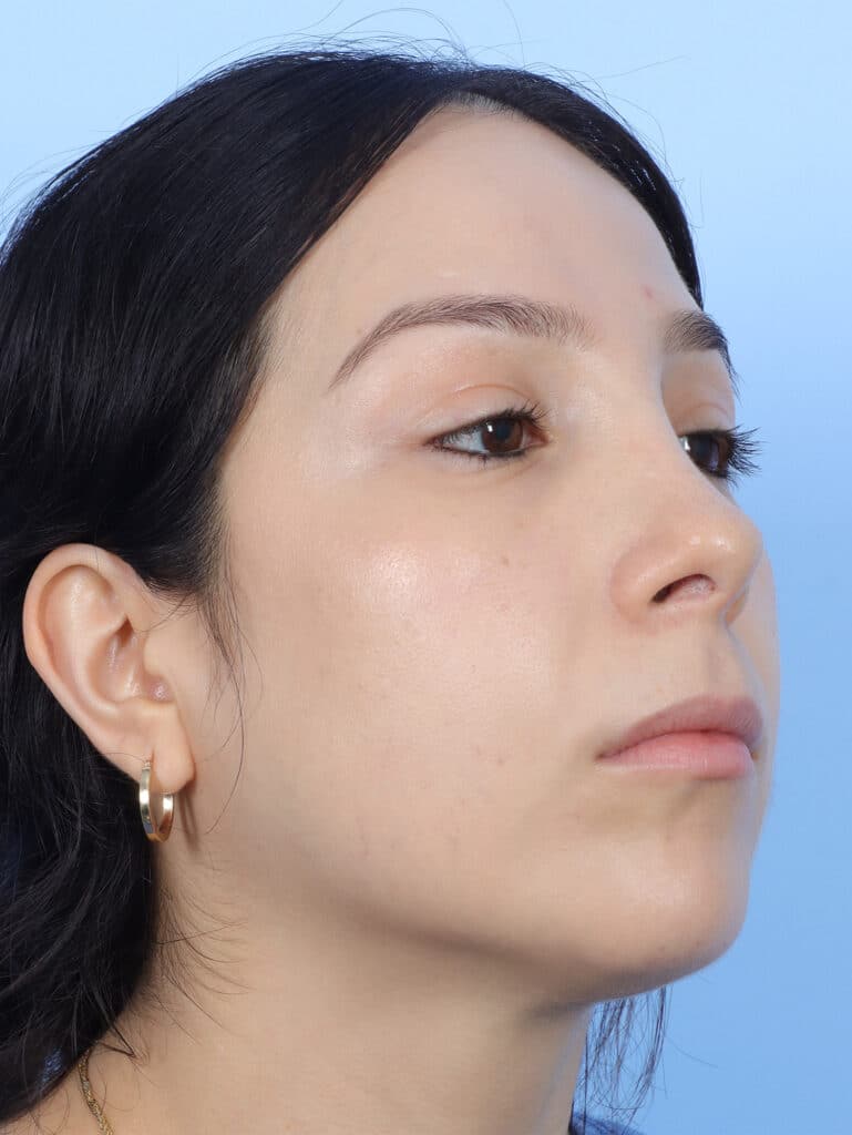 After Image: Rhinoplasty - right-front-oblique
