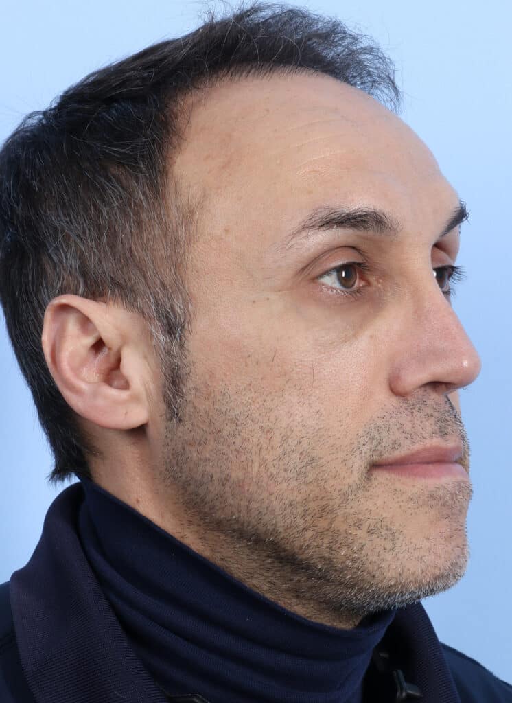 After Image: Rhinoplasty - right-front-oblique
