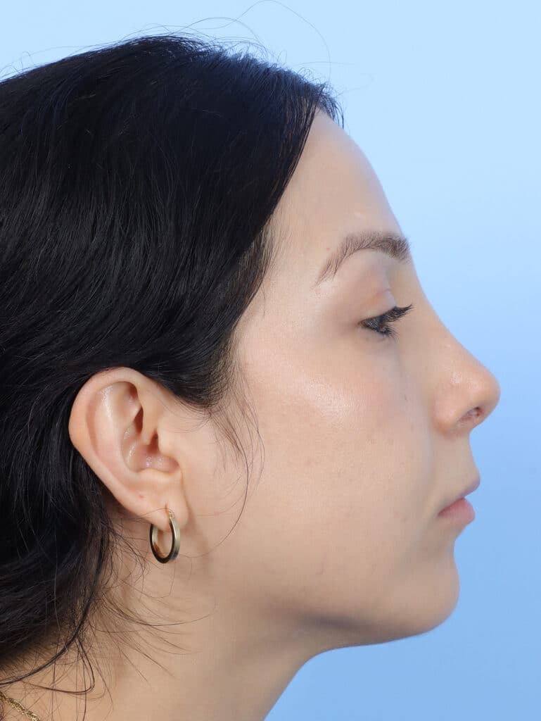 After Image: Rhinoplasty - right-side