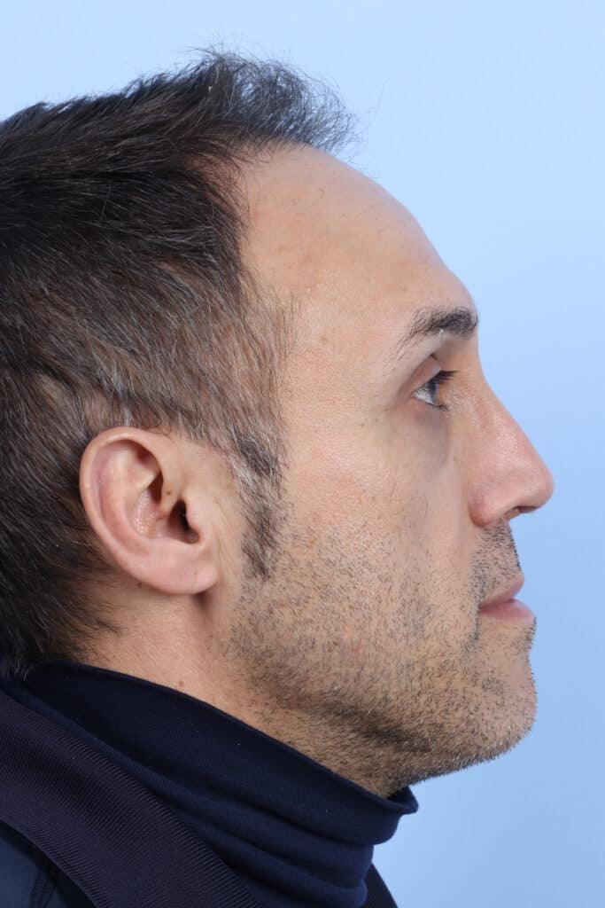 After Image: Rhinoplasty - right-side
