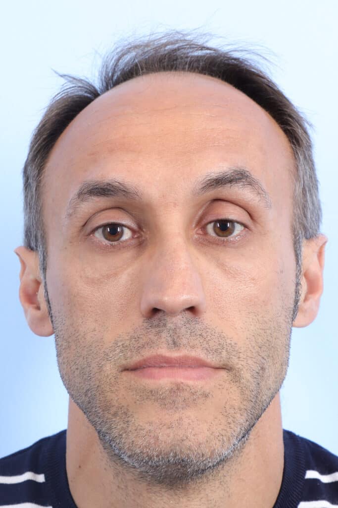Before Image: Rhinoplasty - front