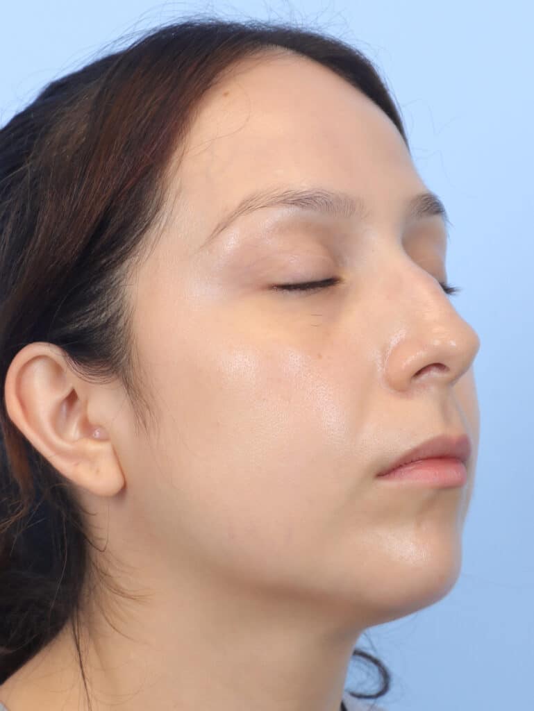 Before Image: Rhinoplasty - right-front-oblique