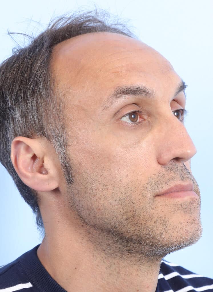 Before Image: Rhinoplasty - right-front-oblique