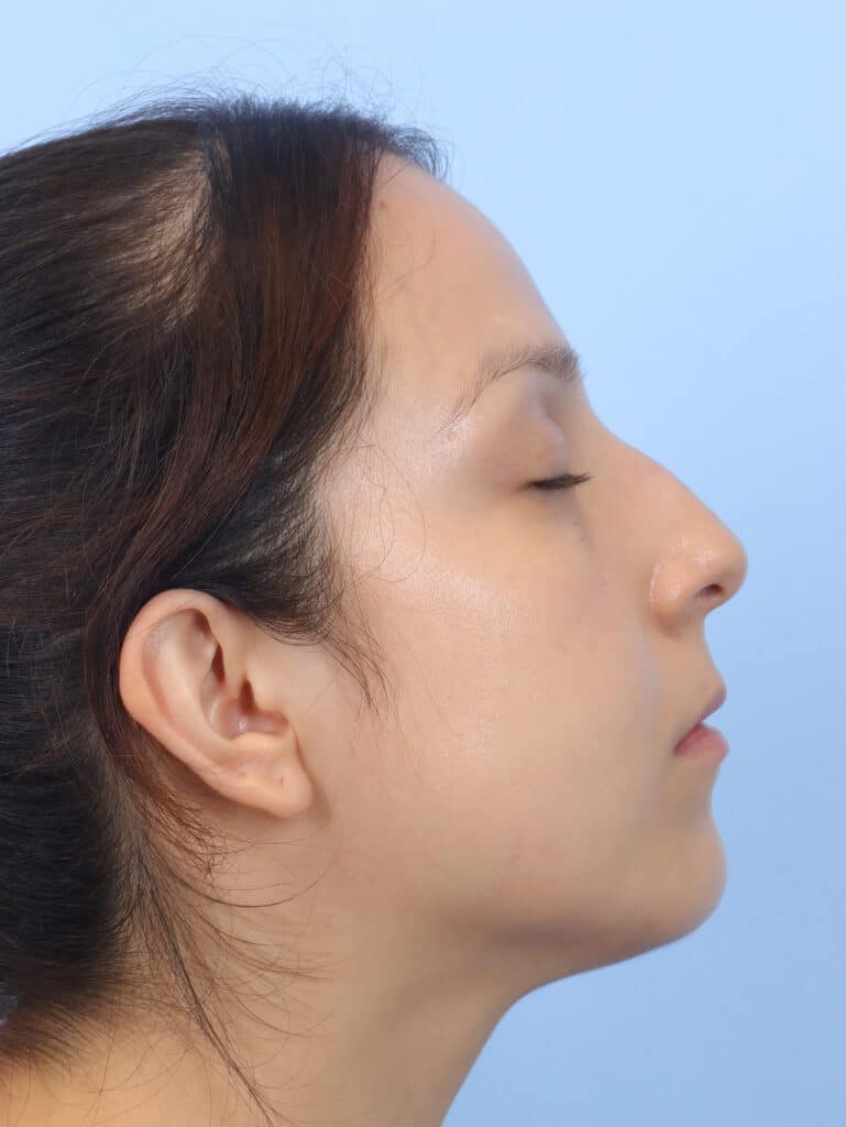 Before Image: Rhinoplasty - right-side